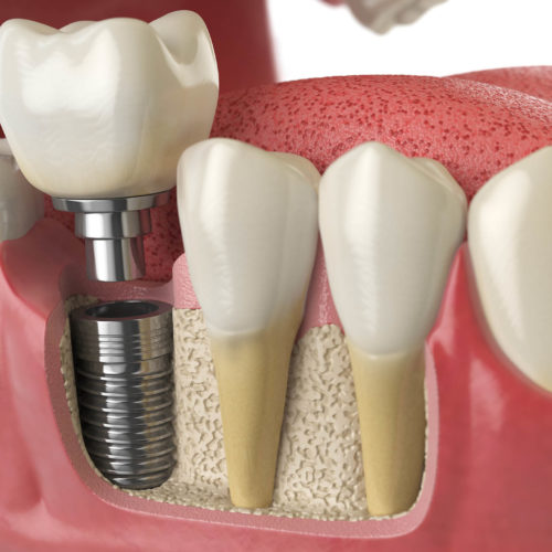 IMPLANTE DENTÁRIO: ESPECIALISTA ALERTA PARA 3 SINAIS DE QUE SEU IMPLANTE PRECISA DE ATENÇÃO