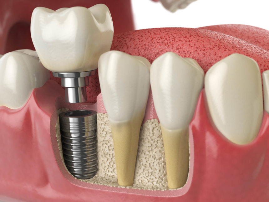 IMPLANTE DENTÁRIO: ESPECIALISTA ALERTA PARA 3 SINAIS DE QUE SEU IMPLANTE PRECISA DE ATENÇÃO