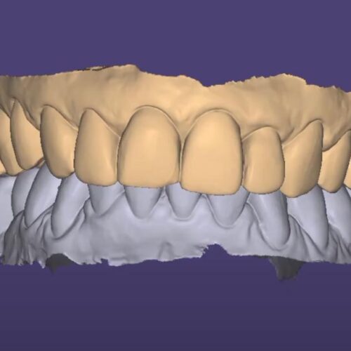 Precisa desgastar os dentes para fazer lentes de contato?