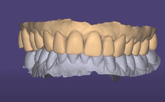 Precisa desgastar os dentes para fazer lentes de contato?