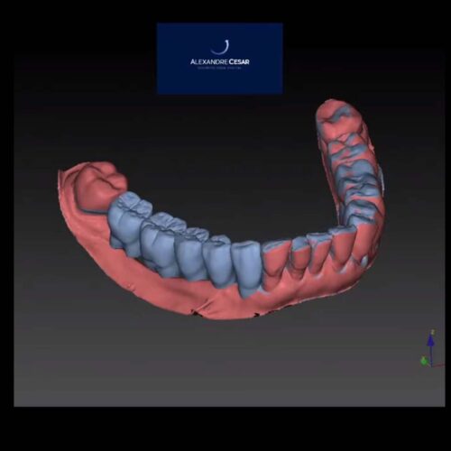 Guia Cirúrgico para Implantes Dentais