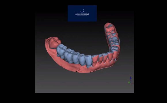 Guia Cirúrgico para Implantes Dentais