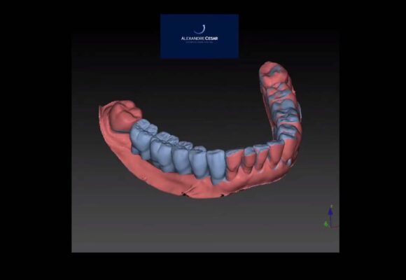 Guia Cirúrgico para Implantes Dentais