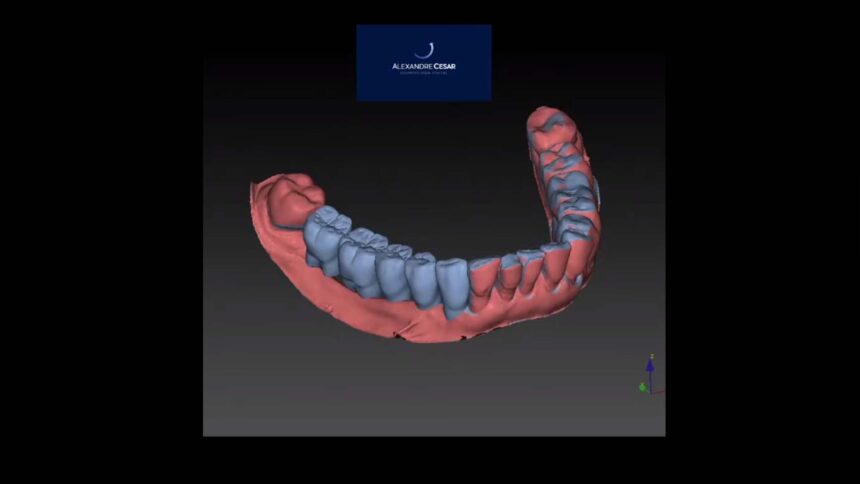 Guia Cirúrgico para Implantes Dentais